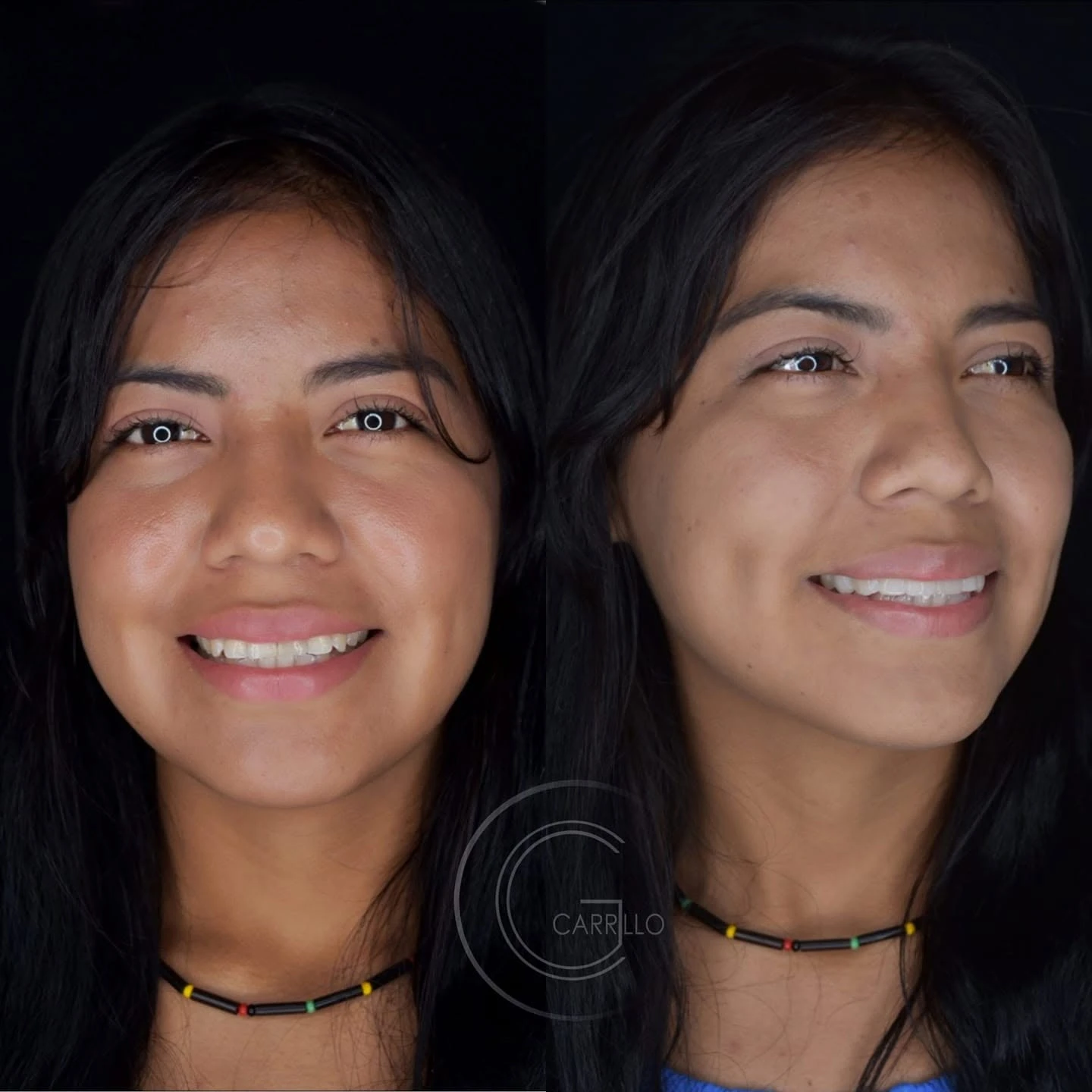 Comparación de una sonrisa antes y después del tratamiento, de frente y de tres cuartos