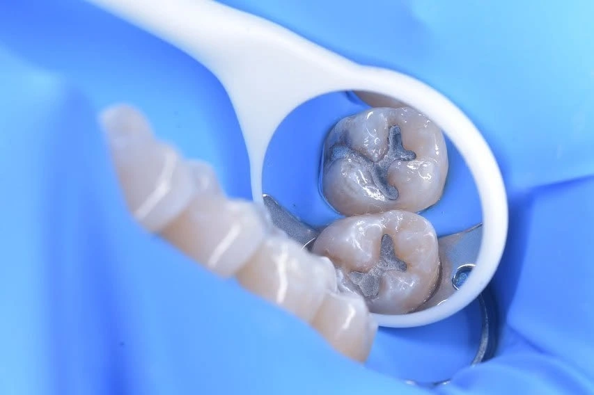Dos molares con manchas oscuras vistos en el espejo dental, sobre aislamiento azul