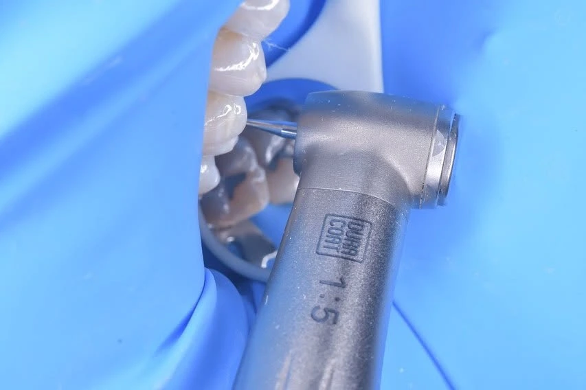Pieza de mano con fresa trabajando sobre un molar, con aislamiento azul