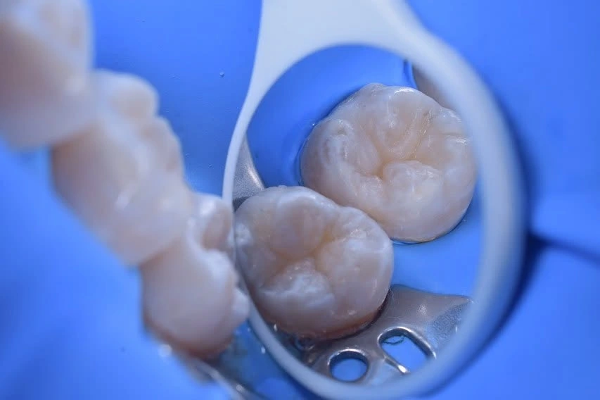 Dos molares con restauración terminada, vistos en el espejo dental