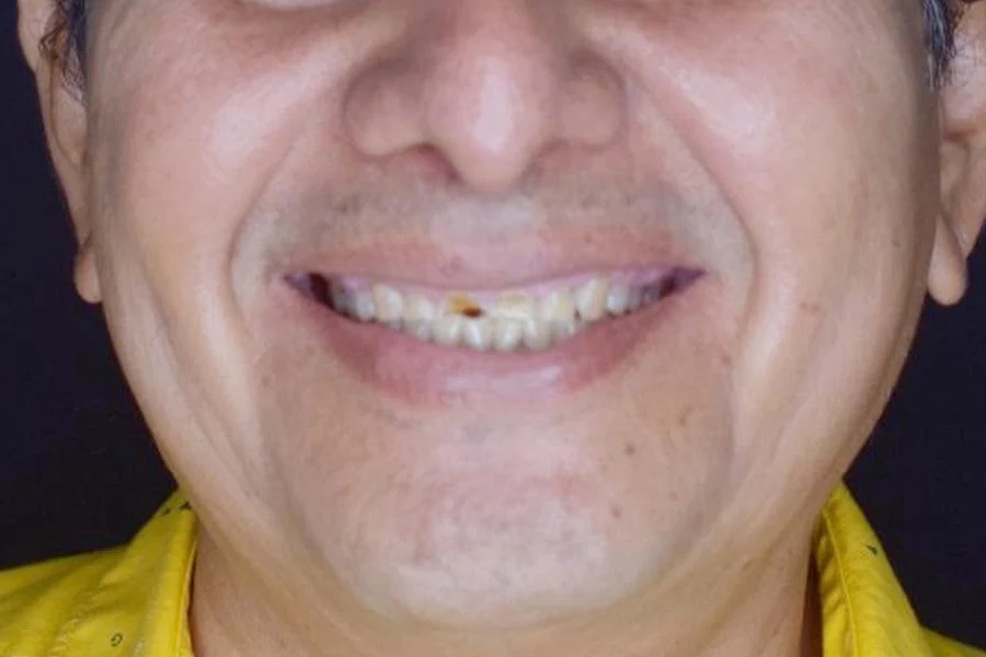 Sonrisa antes del tratamiento, con desgaste y manchas en los dientes frontales