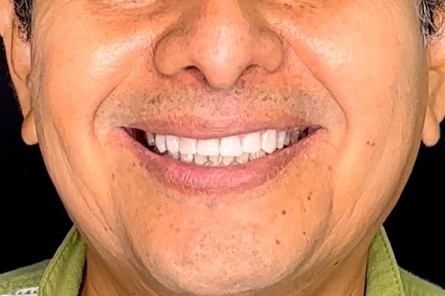 Sonrisa después del tratamiento, con dientes frontales blancos y parejos