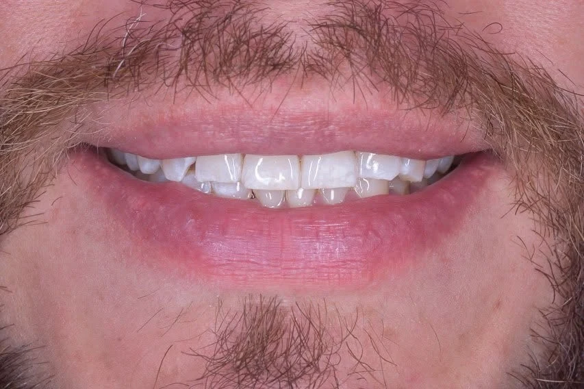 Sonrisa antes del tratamiento, con bordes irregulares en los dientes frontales
