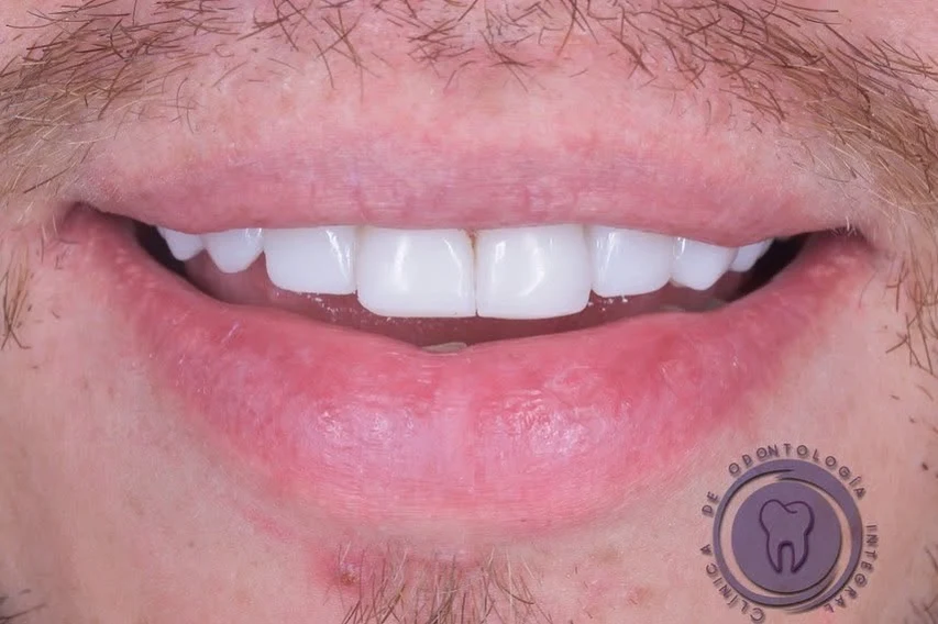 Sonrisa después del tratamiento, con dientes frontales blancos y alineados