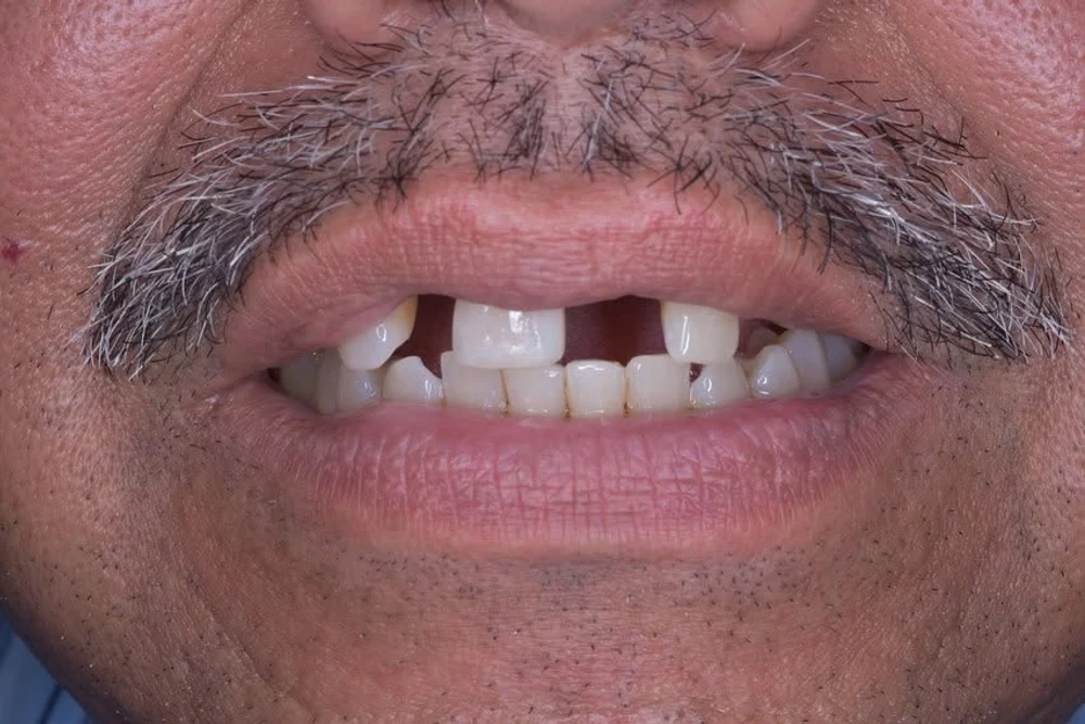 Sonrisa antes del tratamiento, con espacios por piezas dentales faltantes