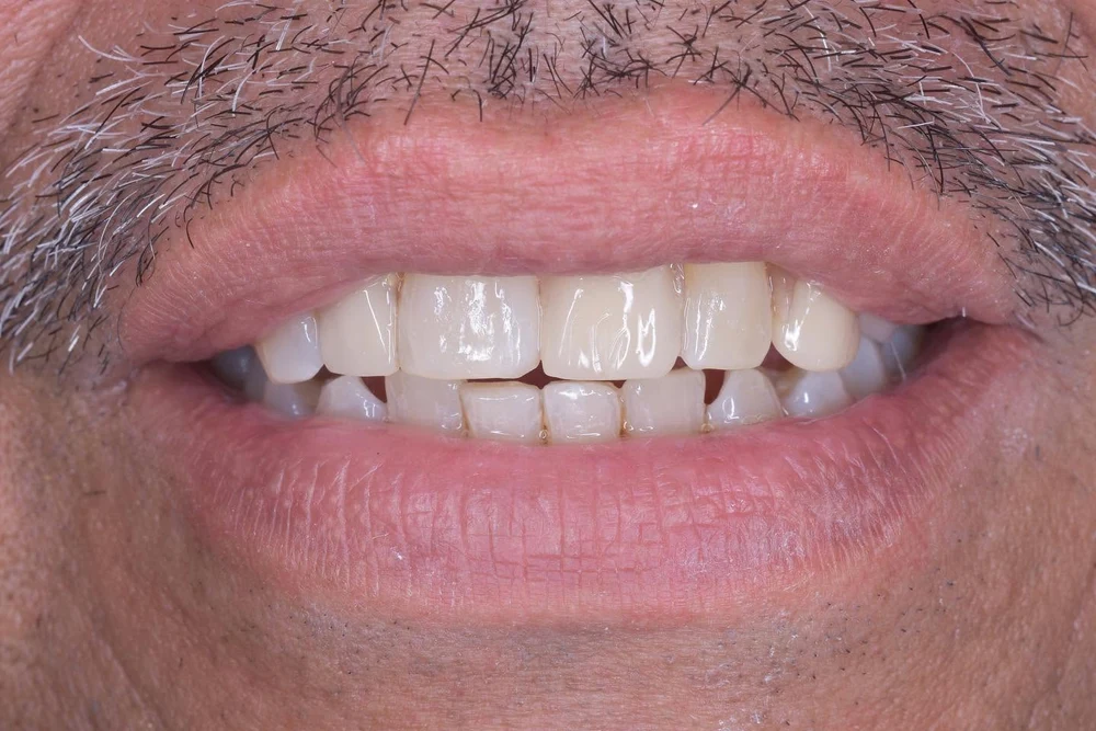 Sonrisa después del tratamiento, con la arcada completa