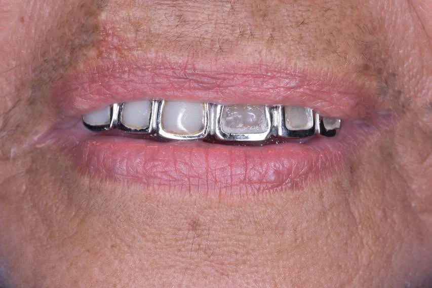 Estructura metálica provisional sobre los dientes frontales