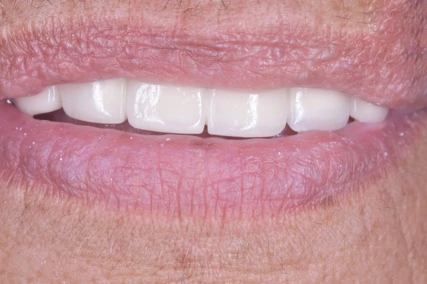 Dientes frontales con restauración final de color natural